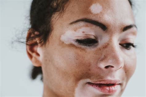 13 000+ Vitiligo Photos, taleaux et images libre de。